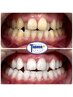 【もう一度白い歯に☆】リターンコース3来店 ¥36,000⇒¥24,300