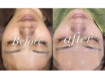 レシェルサロン(Lechelle Salon)/ハーブピーリング＋ダーマエステ