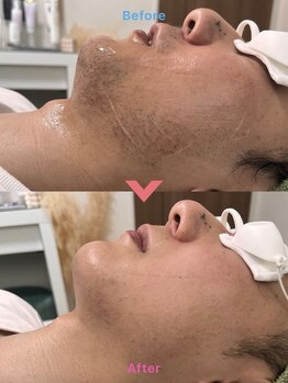 ゴールド(GOLD)/髭脱毛、好評です♪