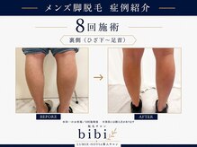 ビビ(bibi)/メンズ足脱毛施術8回（裏側）
