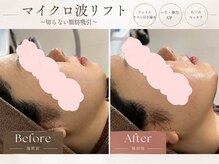 ウナ デ リンゴル 恵比寿店(UNA de Ringol)の雰囲気（マイクロ波リフトで顔の脂肪とたるみを徹底ケア♪）