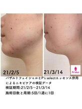 アジャストメント ナチュラル(adjustment natural)/ニキビケアも◎