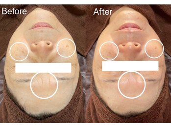 ライチャス(RAICHAS)/陶肌トリートメント１回の効果◎