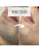 エルモリア(ELMOREA)/痛みに弱い方も◎ヒゲ脱毛！