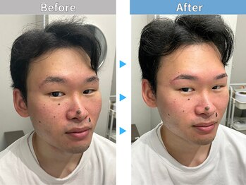 マユクリア 錦糸町店/美眉B/A【眉毛/眉毛サロン】