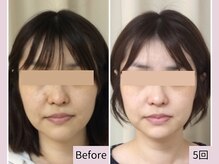 【顔のサイズ】30代女性×顔の大きさはむくみや歪み、たるみ改善など原因は様々？！