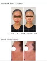 シャンタイン(SANTAI)/★ 美顔器リフト ★