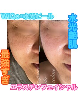 カルマーアンドビー(Calmer & Be.)/【WiQo水光ピール】Before/After