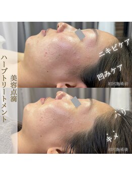 ヴィヴィオドット(vivio.)/ニキビケア・毛穴・たるみケア