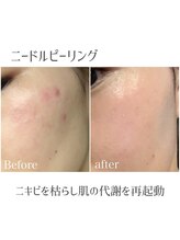 モイ(moi.)/◆マイクロニードルピーリング◆