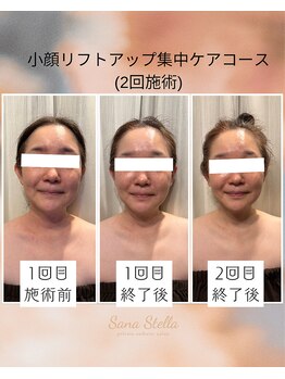 サーナステラ(Sana Stella)/小顔リフトアップ徹底ケア！