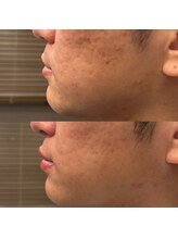 フェリーバ(FELIVA)/Before&After