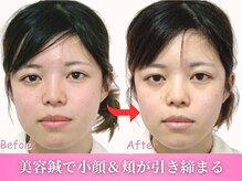 鍼灸整体院ワト 三軒茶屋院(鍼灸整体院WATO)/ ■美容鍼（before→after)