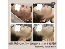 ミノ 美里大通り店(mino)/Ravissaで肌質改善☆