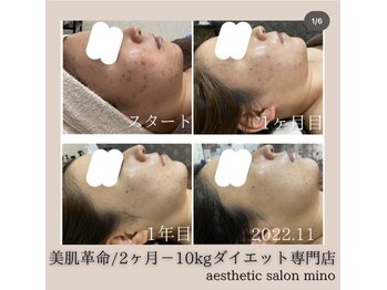 ミノ 美里大通り店(mino)/Ravissaで肌質改善☆