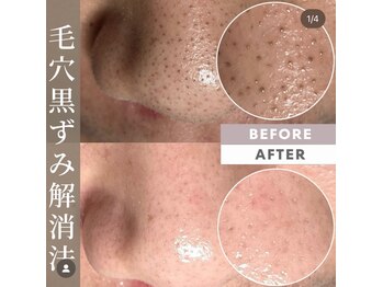 ディエール(Diailes)/毛穴洗浄