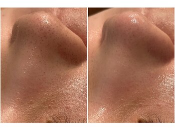 リッツ 大宮店/【Before/After】毛穴