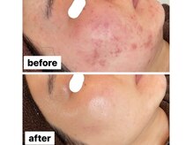 リアリア(LEALEA)/ニキビケア