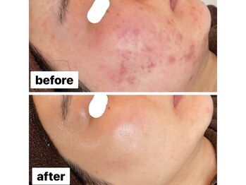 リアリア(LEALEA)/ニキビケア