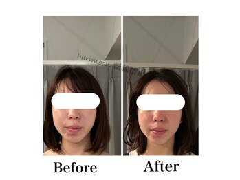 ハリムーン 仙台(harimoon)/ニキビケア