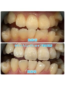 ホワイトニングショップ 津田沼店/before&after美白ホワイトニング
