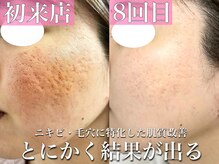 シルキー 新宿店(SILKY)の雰囲気(新宿/ハーブピーリング/フェイシャル/毛穴/毛穴洗浄/ニキビケア)