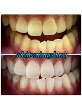 ホワイトニングショップ 吉祥寺店/BEFORE ＆ AFTER