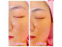 レディースシェービングエステ サンドリオンの雰囲気（【学割U24】産毛もキレイになくなる♪気になるニキビケアにも◎）