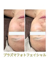 アーク(ARC)/プラズマフェイシャル