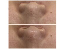 アネラ キキ サロン(anela kiki salon)の雰囲気（お悩みは毛穴とキメの乱れVOSサロンケア1回目から2週間後の変化）