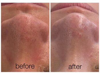 ハリスキンラボ(Hari.Skin.Lab)/30代のお客様/1回の施術効果