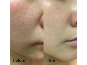 プレシャス(Precious)/肌質改善ハーブピーリング