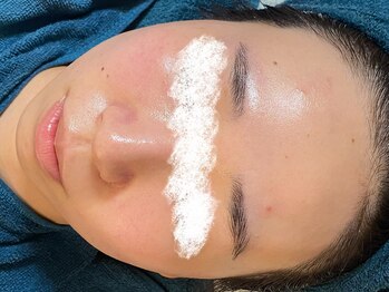 リノルーア(Linolua)/ニキビケアでご来店の方は多数☆