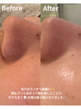ニコ(nico)/黒ずみ毛穴がこんなに綺麗に！