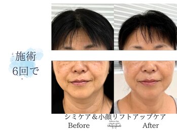 ディアスマイル(Dear.smile)/施術6回で