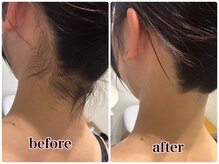 ケースタイル(k.style)/うなじ脱毛
