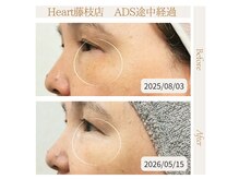 ハート 藤枝店(Heart)の雰囲気（ドクターリセラ導入開始☆シミ改善、リフトアップを短期間で実感）