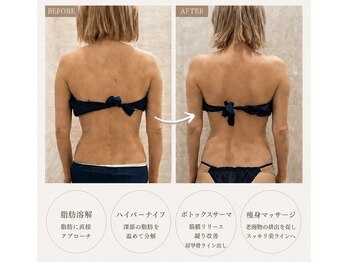 ルナグランデ 心斎橋店(Luna grande.)の写真/【背中・肩甲骨・二の腕集中】背中の厚み・ハミ肉を徹底ケア！美肩甲骨ラインを目指すボディメイク19800円