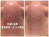 【先着5名様】写真口コミ協力限定♪ハーブピーリング＋毛穴洗浄13,400→5,500