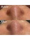 コリー(Kolly)の写真/【美容液で洗う毛穴ケア】で小鼻のくろずみもスッキリ！透明感あふれる素肌を目指す贅沢ケア☆益城/健軍