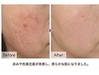 アンナビューティーサロン 博多店/毛穴洗浄・水光ハイドラ