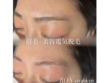 サロンロンウーマン(SALON RON woman)/眉毛脱毛【美容電気脱毛】