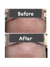 バイカラー(BY COLOR)/【ハイドラ毛穴洗浄】