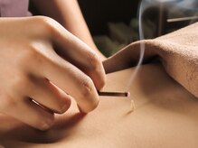 井荻癒し鍼灸院/お灸