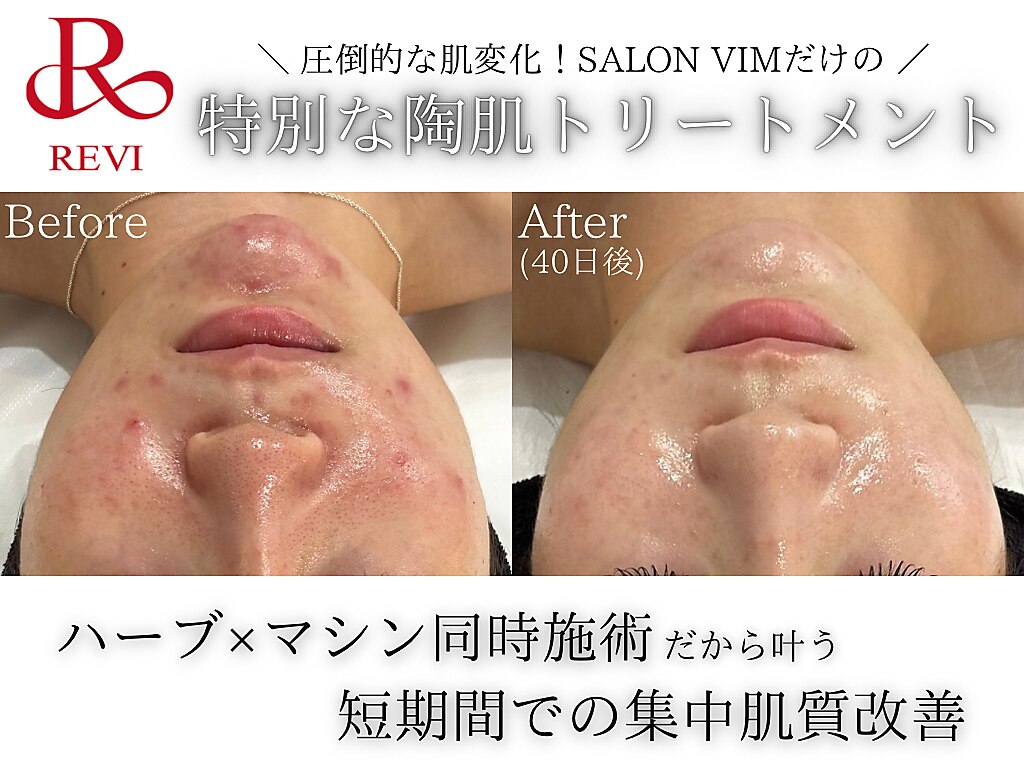 神戸】剥離ありのハーブピーリングができるサロン一覧ができるサロン一覧