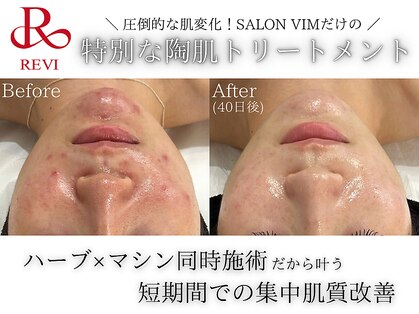 フェイシャルヴィム(FACIAL VIM)の写真