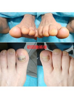 【肥厚・変形爪】ネイル/フット