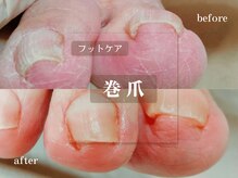 菊桃(kikumomo)/皮膚に食い込んだ巻き爪