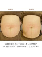 鍼灸治療院エール(YELL)/お腹が引きあがってきました