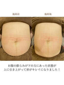 鍼灸治療院エール(YELL)/お腹が引きあがってきました
